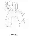 Fig. 02 - EMBOLIC PROTECTION SHIELD