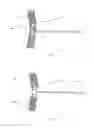 Fig. 05 - FILTER DEVICE FOR CAPTURING EMBOLIC MATERIAL