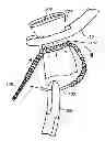 Fig. 01 - Locking suture