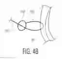 Fig. 08 - Knotless filamentary fixation devices, assemblies and systems and methods of assembly and use