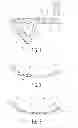 Fig. 02 - Pelvic bone plate