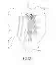 Fig. 08 - Pelvic bone plate