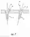 Fig. 08 - Medical device locking mechanisms and related methods and systems