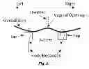 Fig. 10 - Methods and systems for achieving a physiological response by pudendal nerve stimulation and blockade