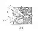 Fig. 03 - Devices for vestibular or cranial nerve stimulation