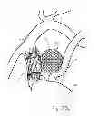 Fig. 35 - Protuberant aneurysm bridging device deployment method