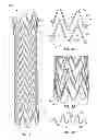 Fig. 02 - Electrospun PTFE coated stent and method of use
