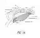 Fig. 02 - Accommodating intraocular lens