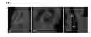 Fig. 02 - Automatic spinal canal segmentation using cascaded random walks