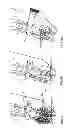 Fig. 07 - Organ removal device and a method for organ removal
