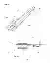 Fig. 08 - Organ removal device and a method for organ removal