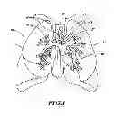 Fig. 02 - Apparatus for injuring nerve tissue