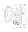 Fig. 02 - Anatomically customized and mobilizing external support, method for manufacture
