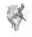 Fig. 06 - Intramedullary resection guide and methods