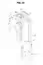 Fig. 13 - Laparoscopic surgical devices having wire reducer
