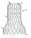 Fig. 01 - PMVR clip configurations for mitral leaflet