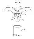 Fig. 10 - PMVR clip configurations for mitral leaflet