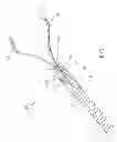 Fig. 02 - Device and method for through the scope endoscopic hemostatic clipping