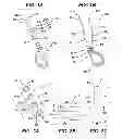 Fig. 02 - Implant having adjustable filament coils