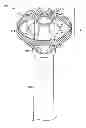 Fig. 01 - VESSEL OCCLUDING MATERIAL EXTRACTOR