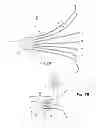 Fig. 08 - Embolus blood clot filter delivery system