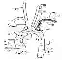 Fig. 01 - Temporary embolic protection device and medical procedure for delivery thereof