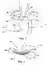 Fig. 02 - Temporary embolic protection device and medical procedure for delivery thereof