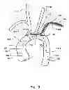 Fig. 03 - Temporary embolic protection device and medical procedure for delivery thereof
