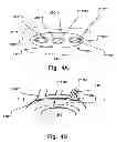Fig. 04 - Temporary embolic protection device and medical procedure for delivery thereof