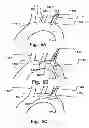 Fig. 05 - Temporary embolic protection device and medical procedure for delivery thereof