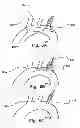 Fig. 06 - Temporary embolic protection device and medical procedure for delivery thereof