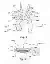 Fig. 02 - Temporary embolic protection device and medical procedure for delivery thereof