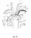 Fig. 03 - Temporary embolic protection device and medical procedure for delivery thereof