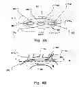 Fig. 04 - Temporary embolic protection device and medical procedure for delivery thereof