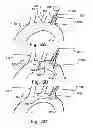 Fig. 05 - Temporary embolic protection device and medical procedure for delivery thereof