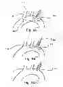 Fig. 06 - Temporary embolic protection device and medical procedure for delivery thereof