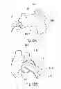 Fig. 10 - Temporary embolic protection device and medical procedure for delivery thereof