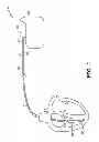 Fig. 02 - Pacing leads with a structured coating