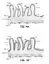 Fig. 06 - Pacing leads with a structured coating