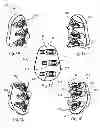 Fig. 02 - Glenoid arthroplasty