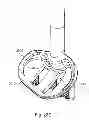 Fig. 49 - Glenoid arthroplasty