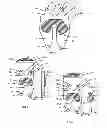 Fig. 02 - Resilient knee implant and methods