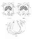 Fig. 03 - Resilient knee implant and methods