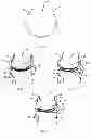 Fig. 05 - Resilient knee implant and methods