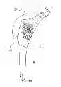 Fig. 01 - ANATOMIC MONOLITHIC HIP IMPLANT SYSTEM