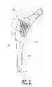 Fig. 03 - ANATOMIC MONOLITHIC HIP IMPLANT SYSTEM