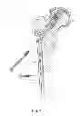 Fig. 02 - Cementless Hip Resurfacing Prosthesis