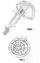 Fig. 03 - Cementless Hip Resurfacing Prosthesis