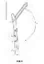 Fig. 04 - Cementless Hip Resurfacing Prosthesis