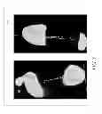 Fig. 06 - Smooth rollover insole for prosthetic foot
